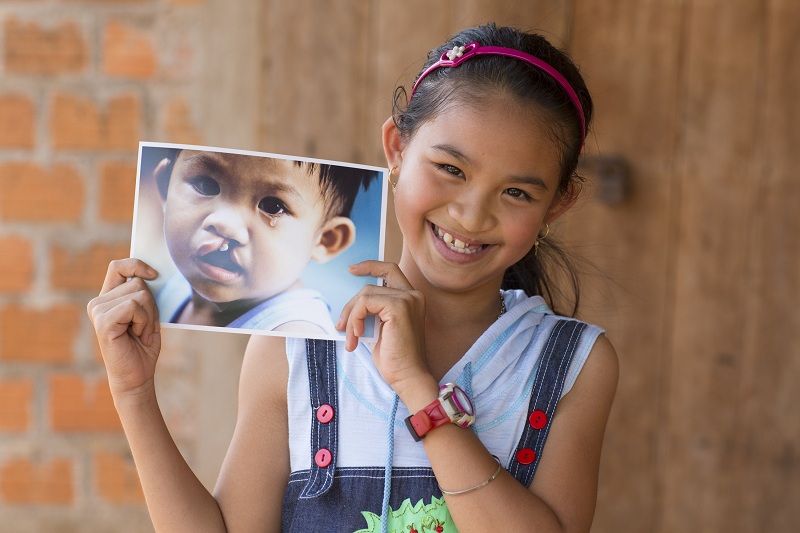 Tập đoàn khách sạn Marriott Việt Nam và Campuchia mở rộng sự hỗ trợ cho tổ chức “Phẫu Thuật Nụ Cười” 